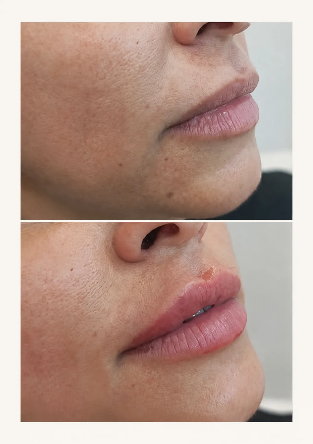 Comparación de relleno de labios con ácido hialurónico
